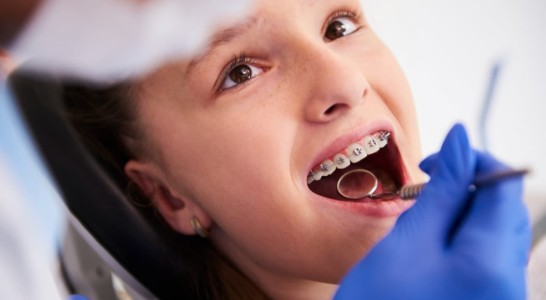 Saiba como cuidar dos dentes depois de tirar o aparelho